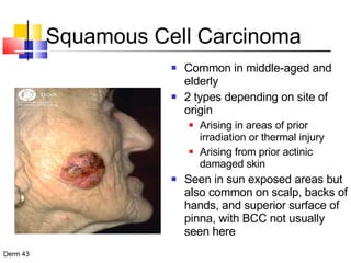 Squamous Cell Carcinoma Common in middle-aged and elderly 2 types depending on site of origin Arising in areas of prior irradiation or thermal injury Arising from prior actinic damaged skin Seen in sun exposed areas but also common on scalp, backs of hands, and superior surface of pinna, with BCC not usually seen here 