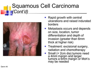 Rapid growth with central ulcerations and raised indurated borders Metastasis occurs and depends on size, location, tumor differentiation and depth of invasion (greater than 6mm thick at higher risk) Treatment: excisional surgery, radiation and chemotherapy Small (< 2cm dia) tumors need a 4mm margin and larger tumors a 6mm margin or Moh’s may be needed Squamous Cell Carcinoma  (Cont’d) 