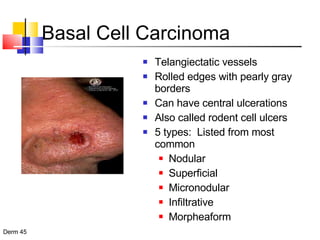 Basal Cell Carcinoma Telangiectatic vessels Rolled edges with pearly gray borders Can have central ulcerations Also called rodent cell ulcers 5 types:  Listed from most common Nodular Superficial Micronodular Infiltrative Morpheaform 