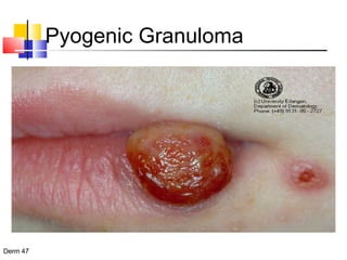 Pyogenic Granuloma 