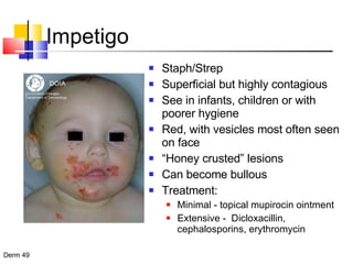 Impetigo Staph/Strep Superficial but highly contagious See in infants, children or with poorer hygiene Red, with vesicles most often seen on face “ Honey crusted” lesions Can become bullous Treatment:  Minimal - topical mupirocin ointment Extensive -  Dicloxacillin, cephalosporins, erythromycin 