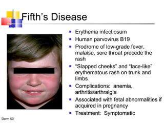 Fifth’s Disease Erythema infectiosum  Human parvovirus B19 Prodrome of low-grade fever, malaise, sore throat precede the rash “ Slapped cheeks” and “lace-like” erythematous rash on trunk and limbs Complications:  anemia, arthritis/arthralgia Associated with fetal abnormalities if acquired in pregnancy Treatment:  Symptomatic 