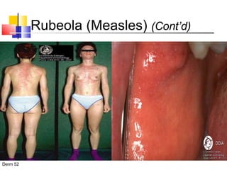 Rubeola (Measles)  (Cont’d) 