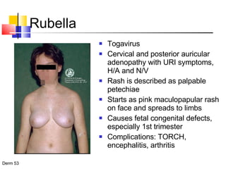 Rubella Togavirus Cervical and posterior auricular adenopathy with URI symptoms, H/A and N/V Rash is described as palpable petechiae Starts as pink maculopapular rash on face and spreads to limbs Causes fetal congenital defects, especially 1st trimester Complications: TORCH, encephalitis, arthritis 