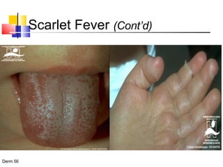 Scarlet Fever  (Cont’d) 