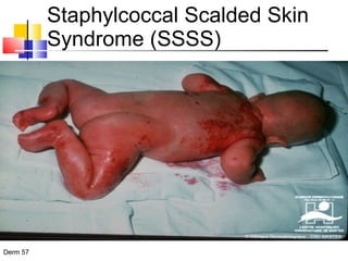 Staphylcoccal Scalded Skin Syndrome (SSSS) 