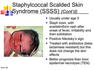 Staphylcoccal Scalded Skin Syndrome (SSSS)  (Cont’d) Usually under age 5 Staph toxin, with scarlatiniform rash after onset of fever, irritability and then exfoliation  Positive Nikolsky’s sign Treated with antibiotics (beta-lactamase resistant) but this does not change the skin effects Better prognosis than toxic epidermal necrolysis (TEN) 