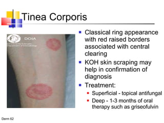 Tinea Corporis Classical ring appearance with red raised borders associated with central clearing KOH skin scraping may help in confirmation of diagnosis Treatment:  Superficial - topical antifungal Deep - 1-3 months of oral therapy such as griseofulvin 