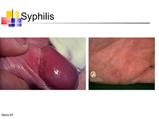 Syphilis 