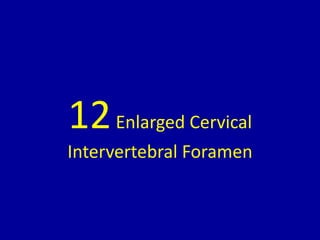 12Enlarged Cervical
Intervertebral Foramen
 