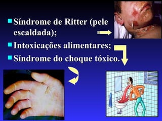  Síndrome de Ritter (pele
  escaldada);
 Intoxicações alimentares;
 Síndrome do choque tóxico.




                               23
 