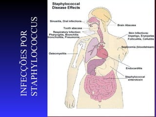 INFECÇÕES POR
     STAPHYLOCOCCUS




24
 