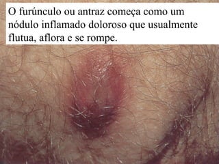 O furúnculo ou antraz começa como um
nódulo inflamado doloroso que usualmente
flutua, aflora e se rompe.




                                           28
 