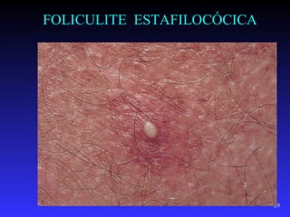 FOLICULITE ESTAFILOCÓCICA




                            29
 