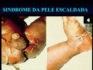 SINDROME DA PELE ESCALDADA




                         31
 