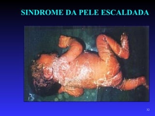 SINDROME DA PELE ESCALDADA




                         32
 