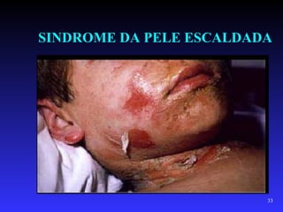 SINDROME DA PELE ESCALDADA




                         33
 