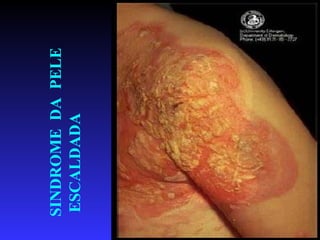 SINDROME DA PELE
     ESCALDADA




34
 
