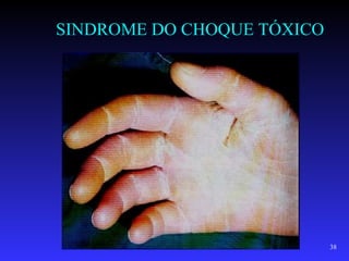 SINDROME DO CHOQUE TÓXICO




                            38
 