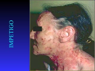 IMPETIGO




41
 