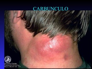 CARBUNCULO




             44
 