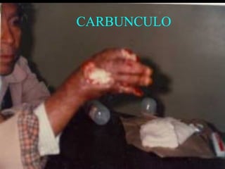 CARBUNCULO




             45
 