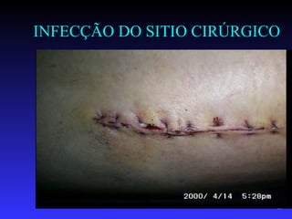 INFECÇÃO DO SITIO CIRÚRGICO




                          48
 