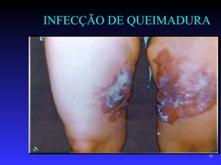 INFECÇÃO DE QUEIMADURA




                     51
 