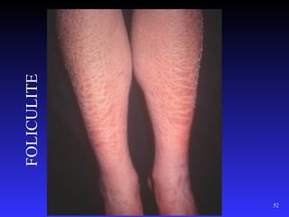 FOLICULITE




52
 