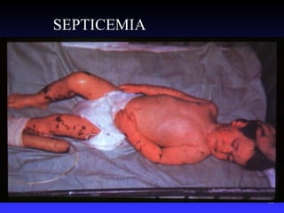 SEPTICEMIA




             53
 