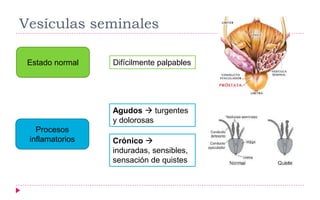 Vesículas seminales
Estado normal Difícilmente palpables
Procesos
inflamatorios
Agudos  turgentes
y dolorosas
Crónico 
induradas, sensibles,
sensación de quistes
 