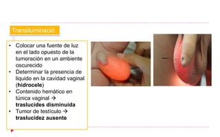 Transiluminació
n
• Colocar una fuente de luz
en el lado opuesto de la
tumoración en un ambiente
oscurecido
• Determinar la presencia de
liquido en la cavidad vaginal
(hidrocele)
• Contenido hemático en
túnica vaginal 
traslucides disminuida
• Tumor de testículo 
traslucidez ausente
 