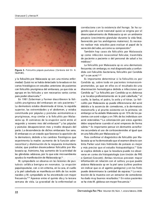foliculitis por malassezia sp