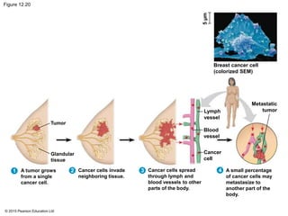 © 2015 Pearson Education Ltd
Figure 12.20
Tumor
Glandular
tissue
A tumor grows
from a single
cancer cell.
1 2 3Cancer cells invade
neighboring tissue.
Cancer cells spread
through lymph and
blood vessels to other
parts of the body.
4 A small percentage
of cancer cells may
metastasize to
another part of the
body.
Cancer
cell
Blood
vessel
Lymph
vessel
Breast cancer cell
(colorized SEM)
Metastatic
tumor
5µm
 