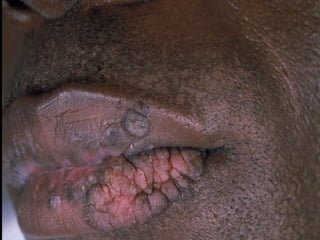 Warts
 Condyloma acuminata are of special
significance in persons with HIV
infection.
 They are very difficult to eradicate.
 Cervical dysplasia and carcinoma are
more frequent and invasive cervical ca
is a case defining illness.
 