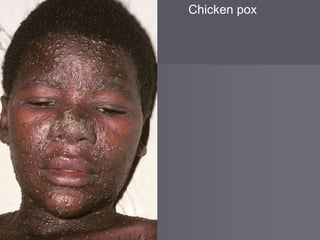 Chicken pox
 