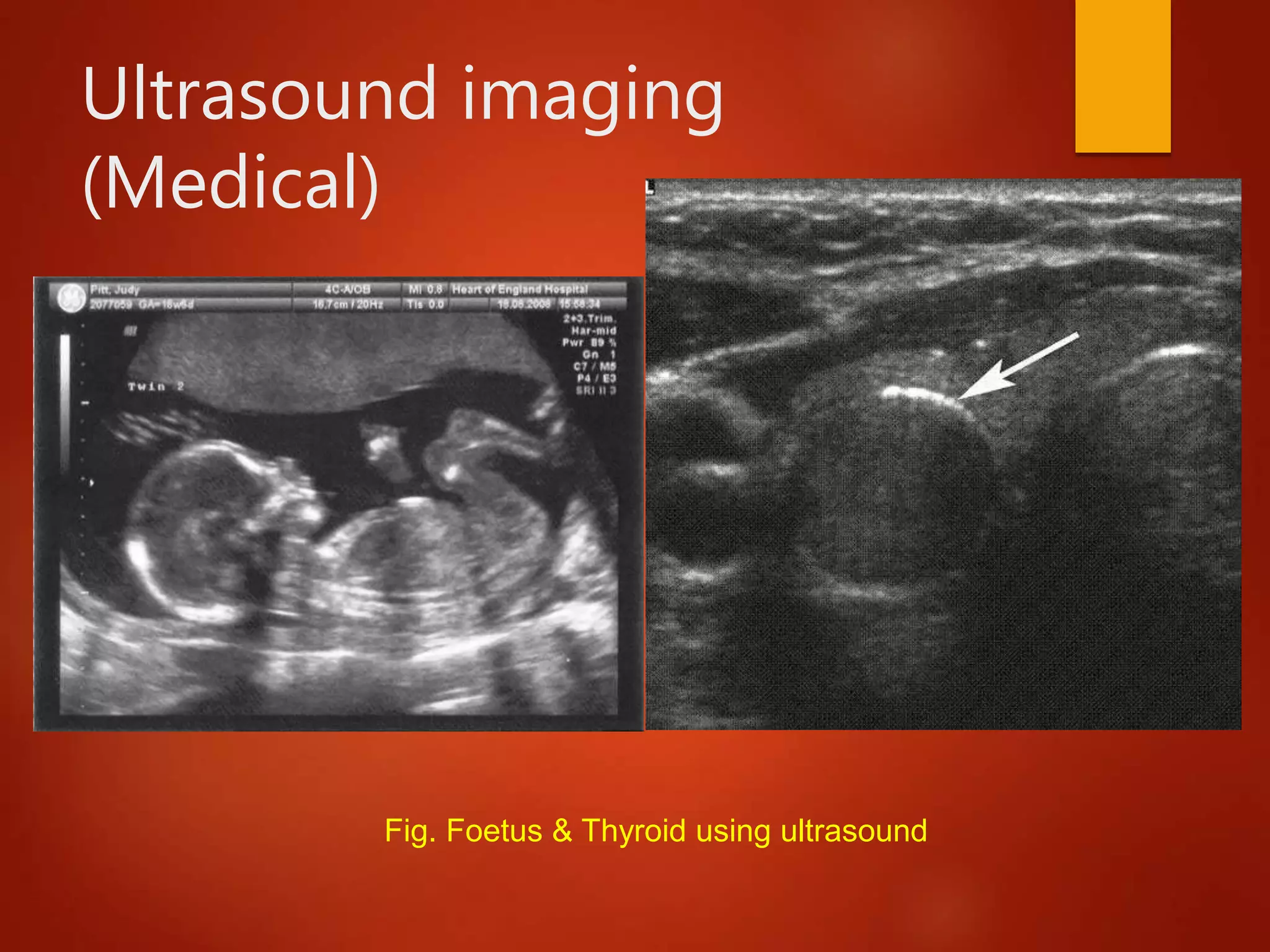 Ultrasound imaging
(Medical)
Fig. Foetus & Thyroid using ultrasound
 