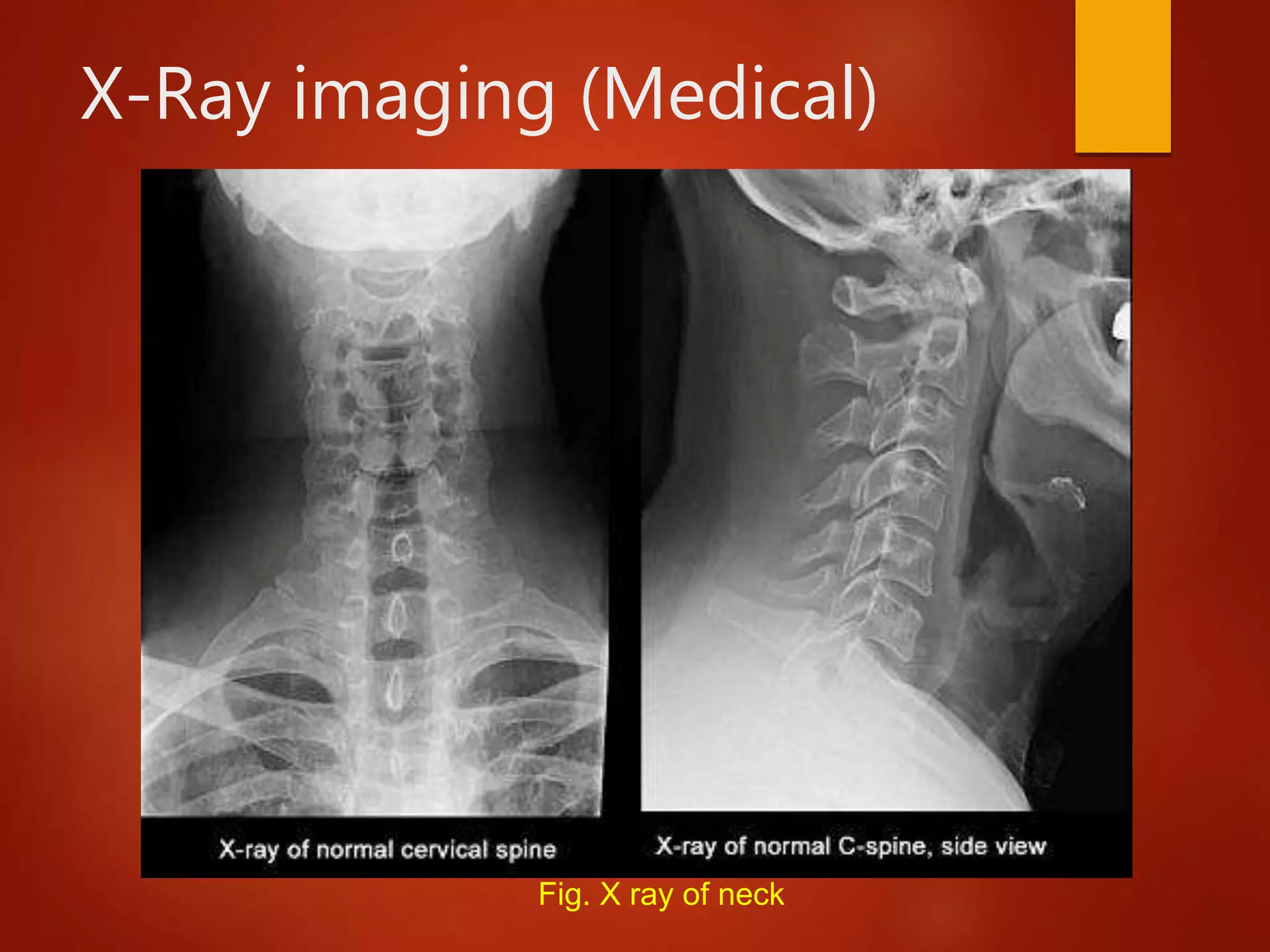 X-Ray imaging (Medical)
Fig. X ray of neck
 