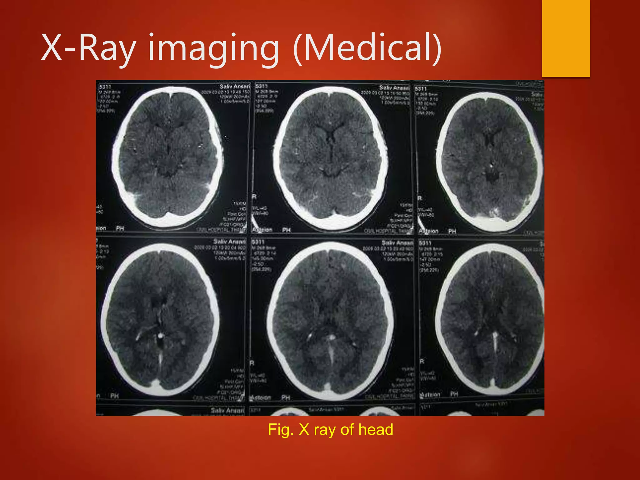 X-Ray imaging (Medical)
Fig. X ray of head
 