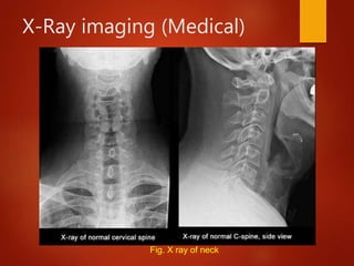X-Ray imaging (Medical)
Fig. X ray of neck
 