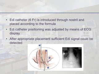 Edi Signals Nonivasive Respiratory Support - NIV, High Frequency Ventilation - HFV ...