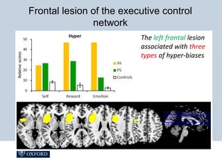 The left frontal lesion
associated with three
types of hyper-biases
Frontal lesion of the executive control
network
 