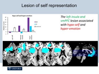 The left insula and
vmPFC lesion associated
with hypo-self and
hyper-emotion
Lesion of self representation
 