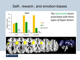 The left frontal lesion
associated with three
types of hyper-biases
Self-, reward-, and emotion-biases
 