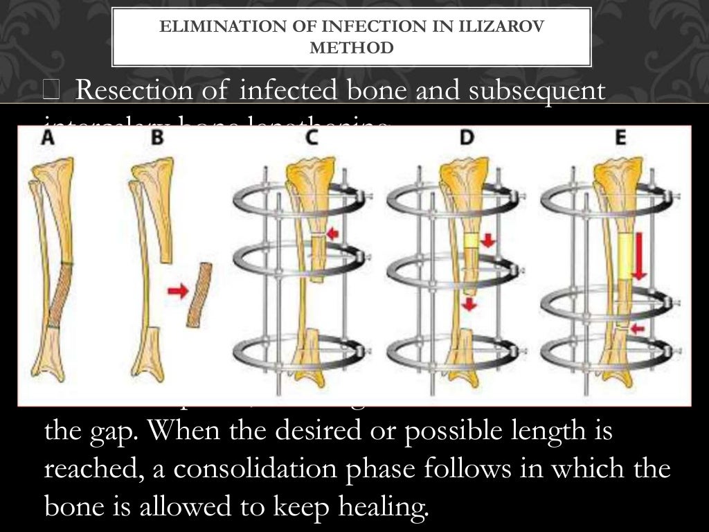 antibiotic coated nails in orthopedic, antibiotic nail