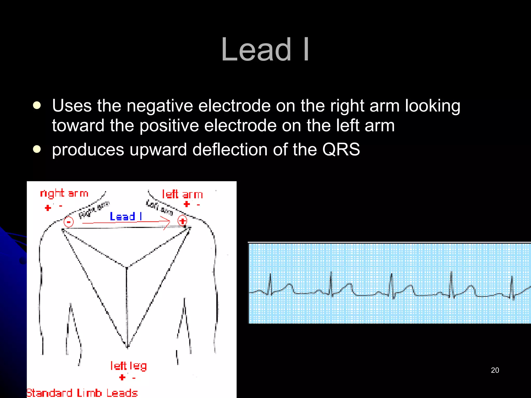 Lead I Uses the negative electrode on the right arm looking toward the positive electrode on the left arm  produces upward deflection of the QRS 