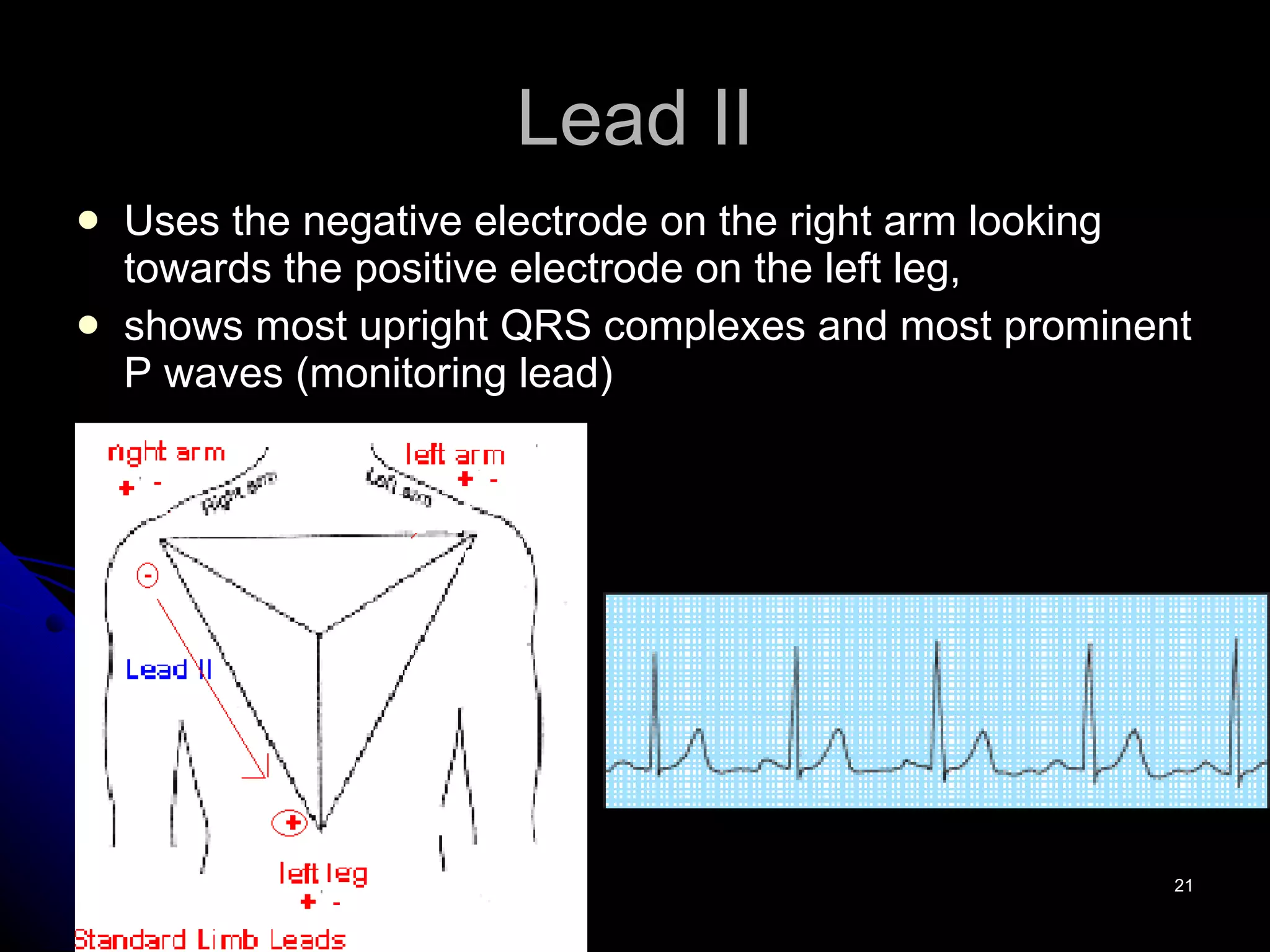 Lead II Uses the negative electrode on the right arm looking towards the positive electrode on the left leg,  shows most upright QRS complexes and most prominent P waves (monitoring lead) 
