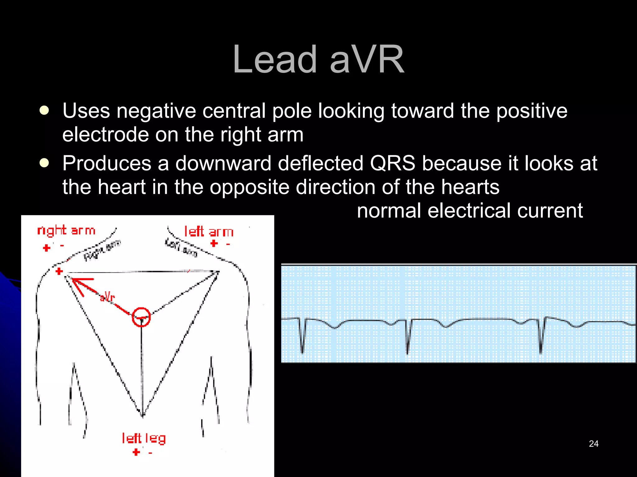 Lead aVR Uses negative central pole looking toward the positive electrode on the right arm Produces a downward deflected QRS because it looks at the heart in the opposite direction of the hearts  normal electrical current 