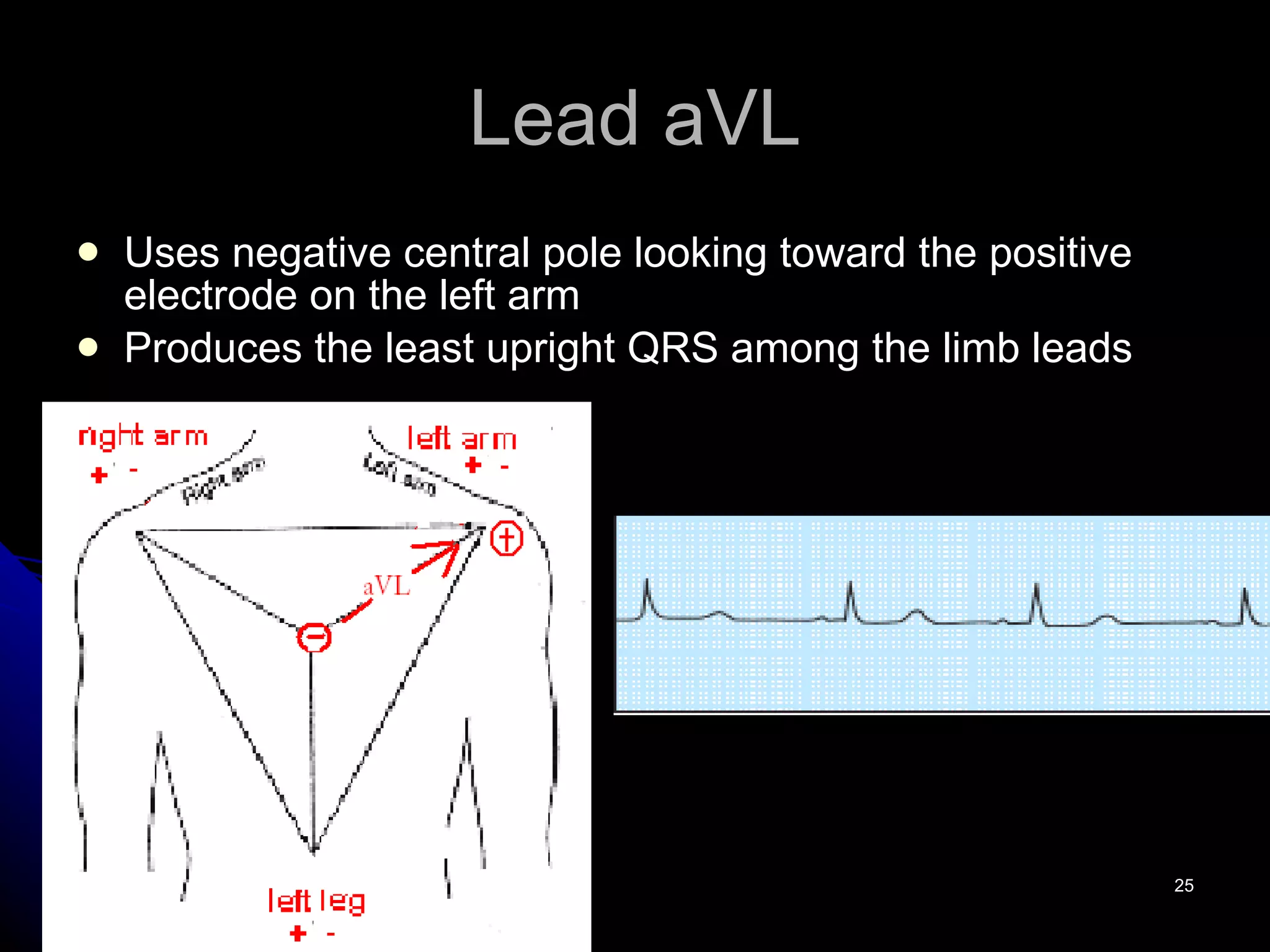 Lead aVL Uses negative central pole looking toward the positive electrode on the left arm Produces the least upright QRS among the limb leads 