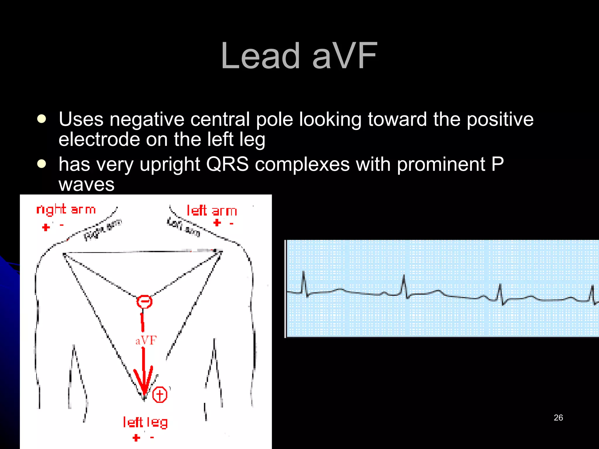 Lead aVF Uses negative central pole looking toward the positive electrode on the left leg has very upright QRS complexes with prominent P waves 